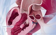 心脏瓣膜置换手术三维动画视频